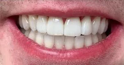 Dentnet Fast protetik - efter