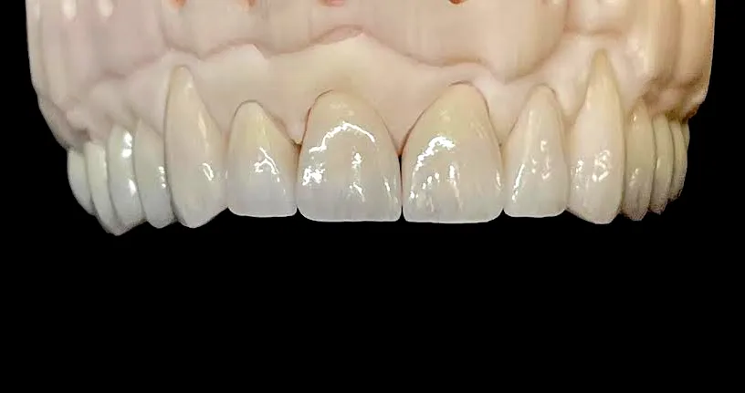 Dentnet - kronor i ök