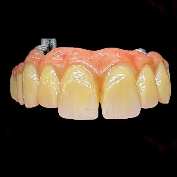 implantat diastema
